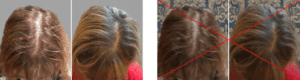 Background of Hair loss before and after photos