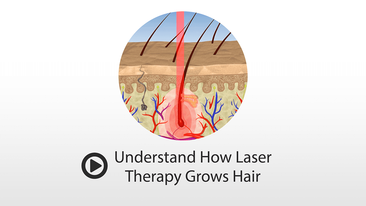 laser hair growth