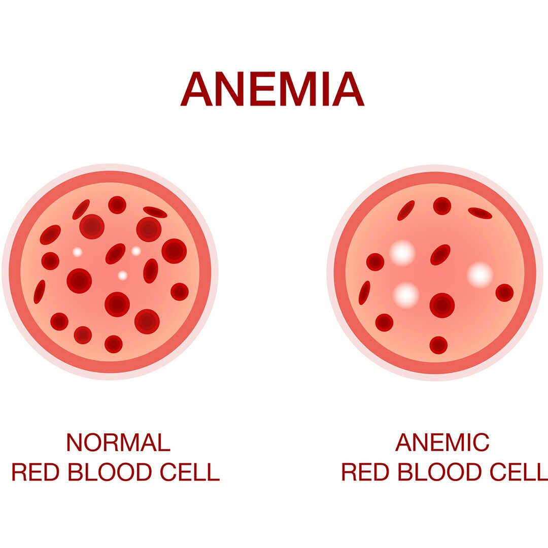 hair loss from anemia