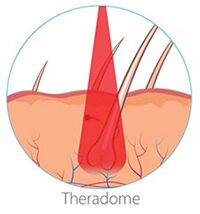 laser hair growth
