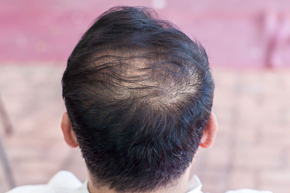 Androgenetic Alopecia in Men